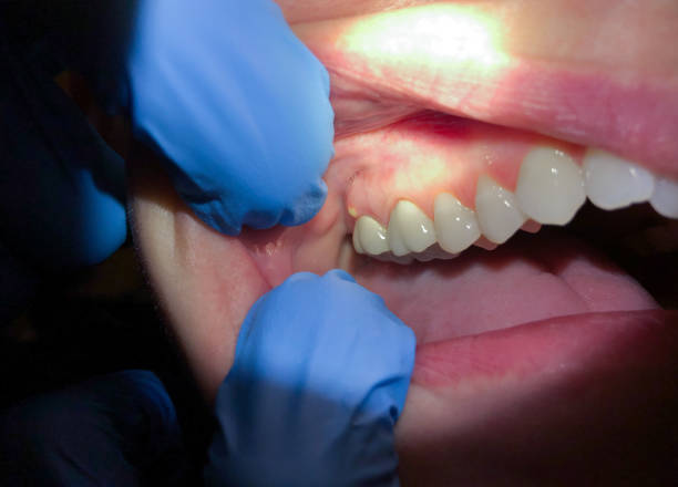 Best Dentist for Tooth Abscess  in St Marys, PA